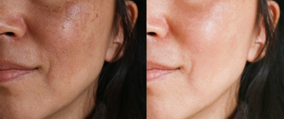 Laser Toning – Derma 9 Skin Rejuvenation Clinic